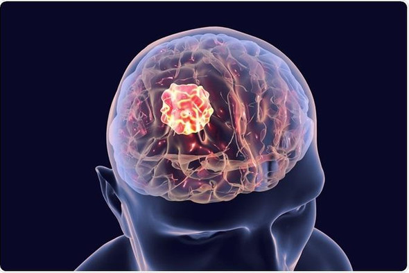 Учёные научились находить признаки рака по «горячим точкам» в мозгу