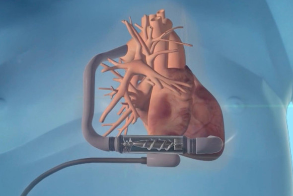 Российские ученые создали аппарат, который поможет малышам дождаться пересадки сердца