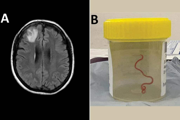 «Живой и извивается»: в мозге женщины нашли червя, который жил там целый год 