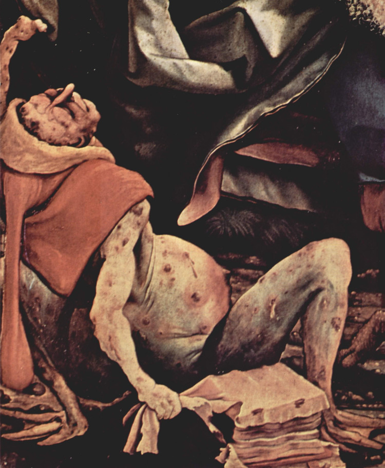 Больной «антониевым огнём» — деталь нижней части правой створки Изенгеймского алтаря, художник Маттиас Грюневальд, предположительно 1506—1515 годы, ныне в музее Унтерлинден, Кольмар (Франция) / Wikimedia Commons